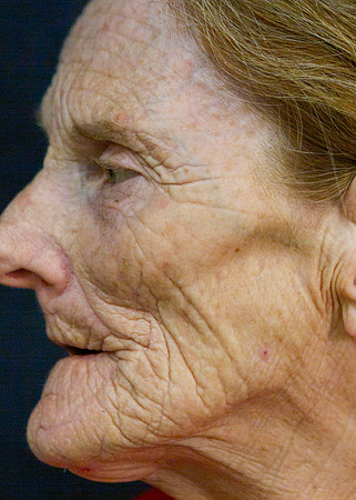IM1_0555Left side chin front cheek eye
