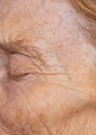 IM1_0571left eye scar