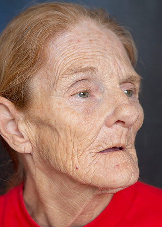 IM1_0560right cheek and indention and unsymmetric face